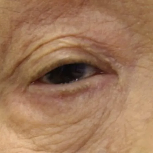 福岡保険診療眼瞼下垂・三重瞼・凹み