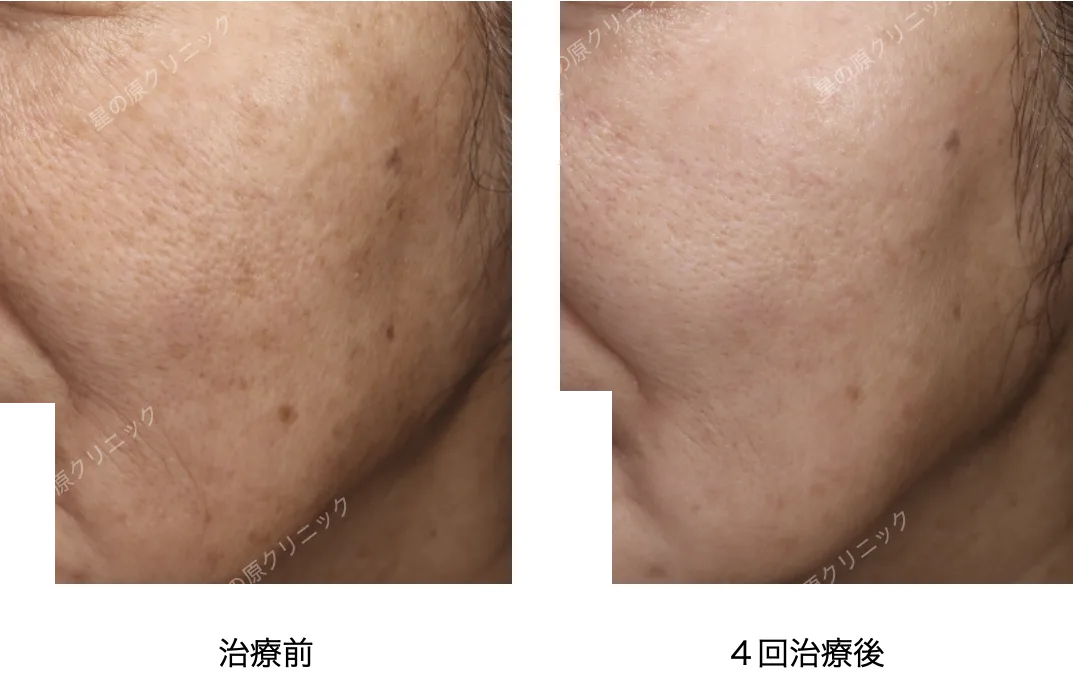 福岡肝斑治療レーザートーニング.ピコトーニング.png 福岡肝斑治療レーザートーニング.ピコトーニング