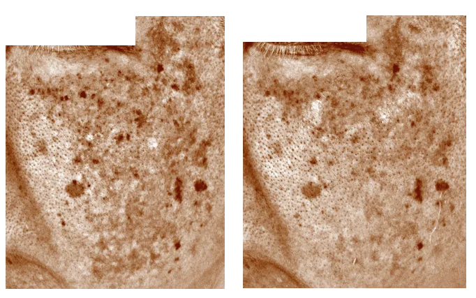 ◎20344L済福岡肝斑治療レーザートーニング.ピコトーニング