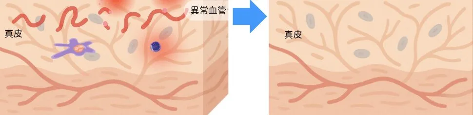 福岡肝斑治療.png 福岡肝斑治療