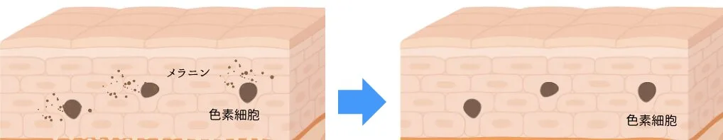 福岡肝斑治療.png 福岡肝斑治療