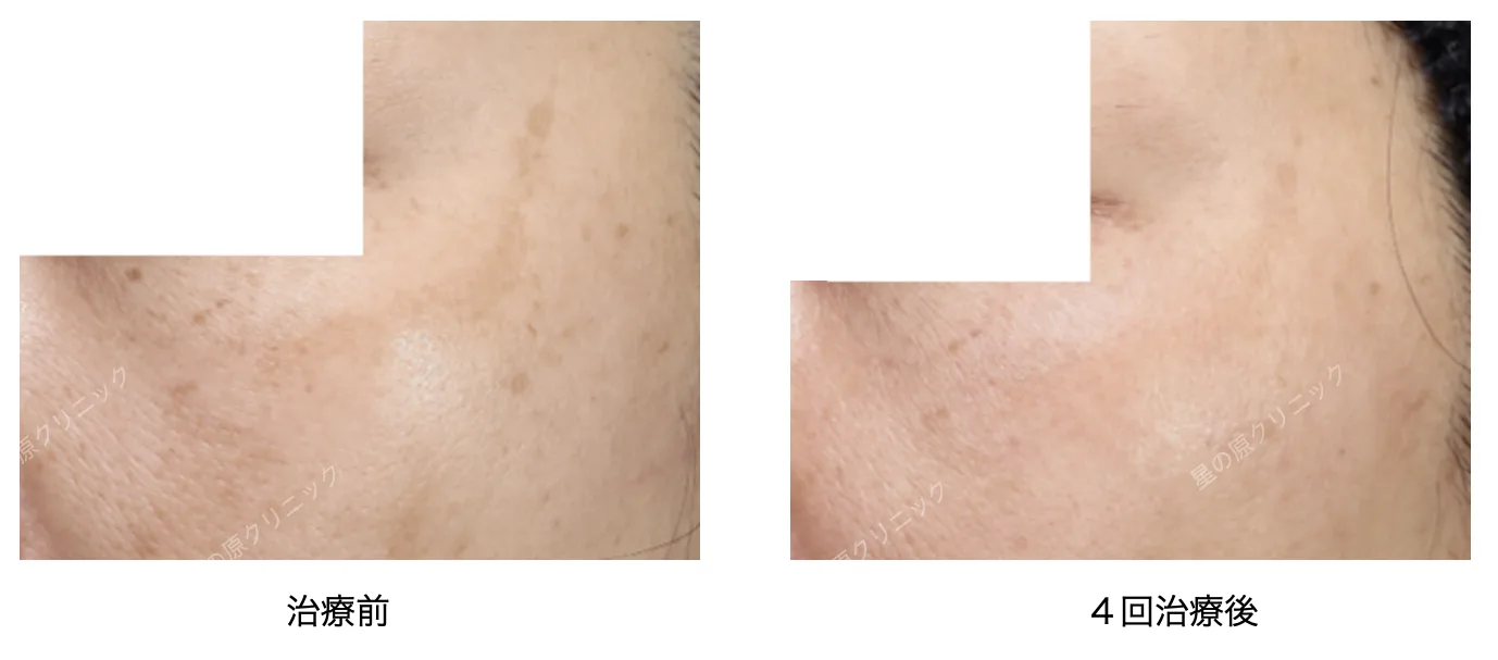 福岡肝斑治療レーザートーニング.ピコトーニング2.png 福岡肝斑治療レーザートーニング ピコトーニング2