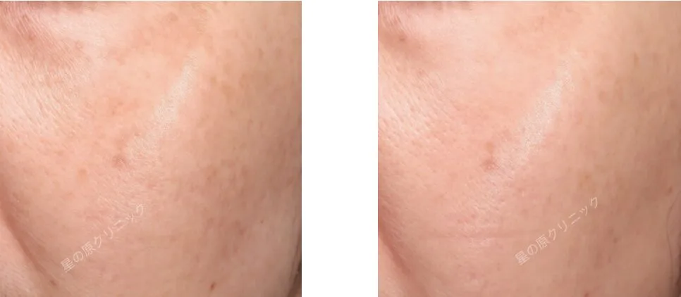 福岡肝斑治療レーザートーニング.ピコトーニング.png 福岡肝斑治療レーザートーニング.ピコトーニング