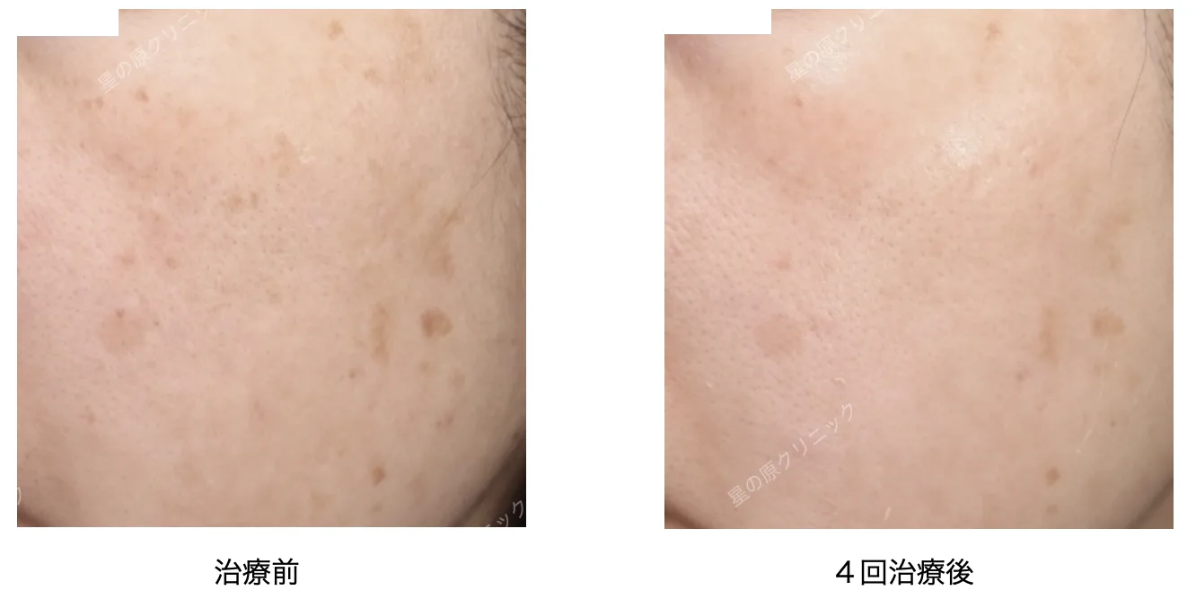 福岡肝斑治療レーザートーニング ピコトーニング