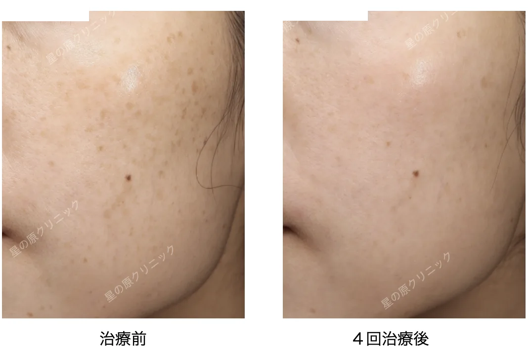 福岡肝斑治療レーザートーニング.ピコトーニング.png 福岡肝斑治療レーザートーニング ピコトーニング