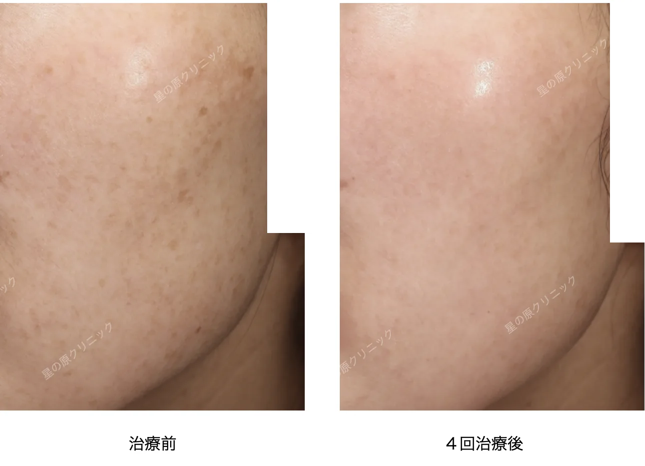 福岡肝斑治療レーザートーニング.ピコトーニング.png 福岡肝斑治療レーザートーニング ピコトーニング