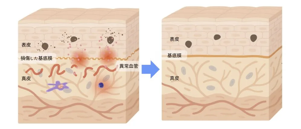 真皮のリモデリング