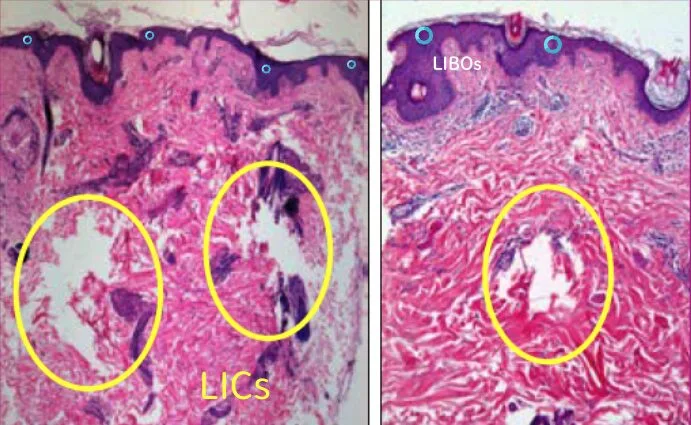 LIBO LICS.png LIBO LICS