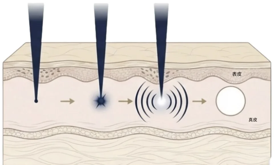 福岡、ピコフラクショナル.png 福岡、ピコフラクショナル