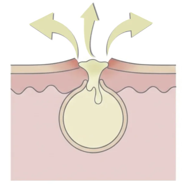 粉瘤破裂.png 福岡、粉瘤、大きなったり小さくなったり