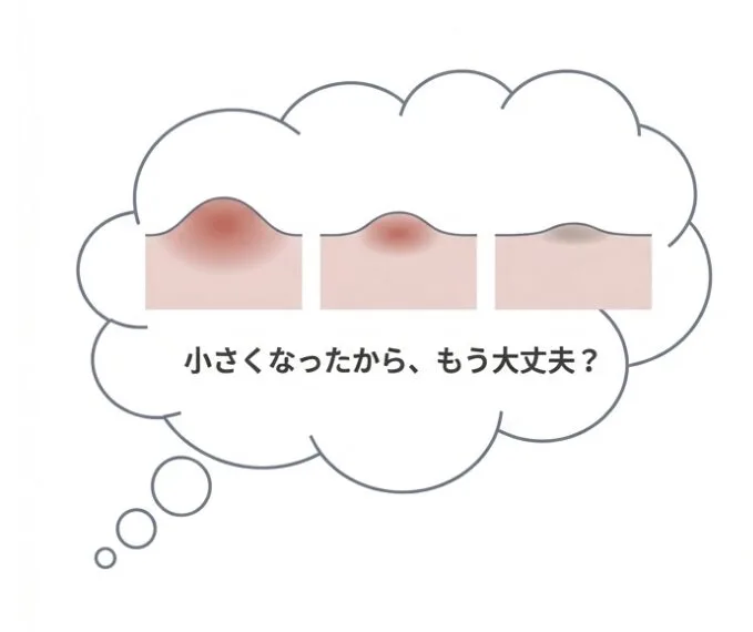 粉瘤、福岡、大きくなったり小さくなったり