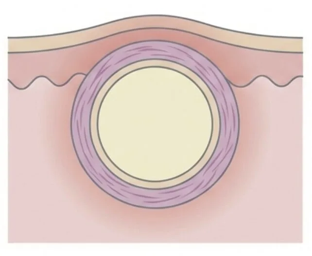 粉瘤閉じ込め.png 福岡、粉瘤、大きなったり小さくなったり