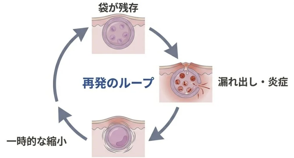 粉瘤のサイクル.png 福岡、粉瘤、大きなったり小さくなったり