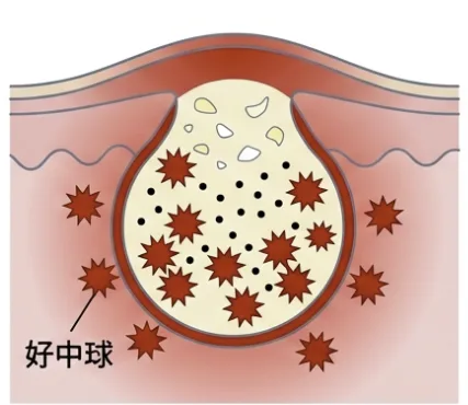 激しい炎症.png 福岡、粉瘤、大きなったり小さくなったり.png